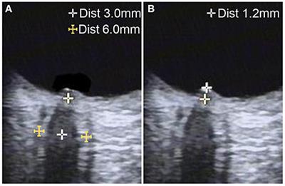 Eye-Neck Integrated Ultrasound in Idiopathic Intracranial Hypertension and Cerebral Venous Sinus Thrombosis